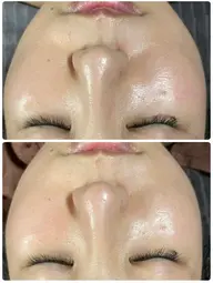 ✨ミニモ限定✨毛穴洗浄