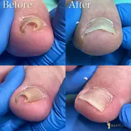 【巻き爪補正】痛みがある方❗️痛みがなくても巻きが強い方⚠️専用の器具で優しく、効果的に施術いたします。
