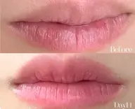 【最新技術ローマピンク💗唇】黒ずみをアナタ本来のピンク肌へ..✨　アフタークリーム13,200円無料プレゼント🎁