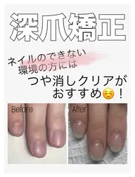 深爪矯正【長さ出し】◆カラーなし◆(オフ込)むしったり割れたり噛んで小さくなってしまった爪も美しく綺麗な状態に✧︎