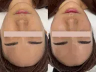 【小顔×毛穴】小顔リンパマッサージ＆毛穴洗浄ハイドラフェイシャル＆潤うコラーゲンパック¥22,000→¥9990