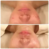 ミニモ限定【ニキビケア/毛穴ケア】肌別ピーリング＋お悩み別ケア＋パック（仕上げUVクリーム）