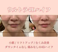 【何度でも同価格】小顔はいふ❤️‍🔥切らない小顔･リフトアップ 3層打ち✨全顔