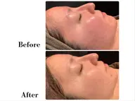 【酒さの方専用肌管理コース】守り＆育てる🌱ケアで赤み敏感肌の改善へ🫧