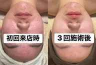 【モニター募集3回セット】本気の肌質改善🌿ハーブピーリング(剥離あり)+フェイシャルマッサージ付