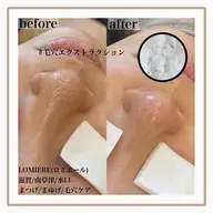 毛穴エクストラクション