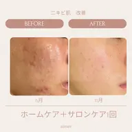 ニキビ肌、跡、ニキビレス“細胞活性機械”セルサーコース*新規様限定*女性専用*マッサージ付き*初回限定価格