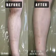 🍀ミニモ限定ペア割🍀ご友人同士や夫婦👫カップル👩‍❤️‍👨同時施術【お試し】全身脱毛 (顔、VIO全パーツ込)