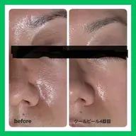毛穴ケア・毛穴引締&トーンUP✨ダウンタイムなしのピーリング+レチノール +ビタミンCイオン導入🫧 1回9,000円