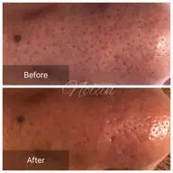 【ご新規様は注意事項を確認の上、ご予約ください】毛穴詰まりすっきり❗️毛穴吸引付きフェイシャル🌈