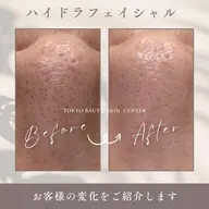 【毛穴詰まりザラザラいちご鼻】ウォーターピーリング毛穴洗浄フェイシャル&美白潤いチャージパック&LEDコラーゲンマシン✨