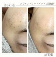 【お試しシミケア】シミケア30分
