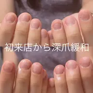 【初回カウンセリング無料】深爪緩和