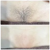 モニター様募集!即効ツルツルずっとツルツル【VIOワックス脱毛+光脱毛】★ダブル脱毛で来店日からずっとツルスベ♪女性限定