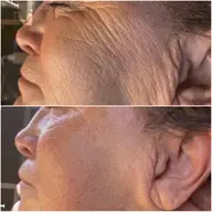 プロセルセラピーズ（顔）✨クレーター、赤ら顔、毛穴、しわ、たるみ、しみ等々🙆‍♀️10回のエステより1回のプロセル👍