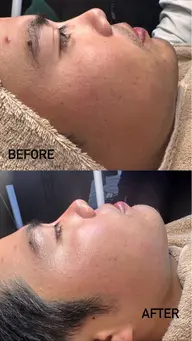 クリスティーナ ハーブピーリング🌿➕毛穴ケア