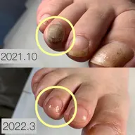 トラブル爪＊肥厚、重複、変色、剥離、伸びない、モニターさん50%OFFにて募集中！通常足の親指一指11,000円のところ