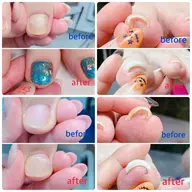 ⭐️11200円➡️7900円⭐️巻き爪、陥入爪、トラブルフットケアモニター様募集⭐️