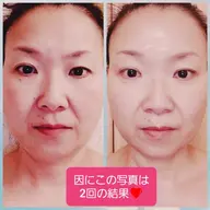 １０周年アニバーサリー💝プラズマシャワー×ナチュラル整形®️3回ケア　お肌診断付き