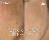 EMS×プラズマ肌質改善フェイシャル☺️💕しみ/しわ/たるみ/むくみ/くすみ/毛穴/ニキビ