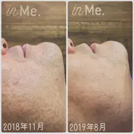 🍀メンズヒゲ脱毛🥸🍀メンズのお顔全体の脱毛です✨しぶといヒゲを無くしていき剃刀負けの肌荒れもみるみる綺麗に💓