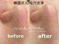 SNSで話題🤍韓国式3D毛穴洗浄𓂃 𓈒𓏸◌