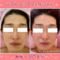 【新規】ほうれい線、たるみに◎ウルトラ筋膜リリース&リフトアップフェイシャル💆♀️(60分)