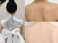 【背中美人】ニキビ/黒ずみ/色素沈着など改善　　(背中+頸+腕+脇+デコルテ)  目安施術時間90分