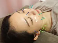 【新規限定】美容鍼+ヘッドマッサージ カウンセリング付 70分 ¥4,300