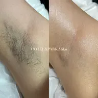 【両脇ワックス脱毛】