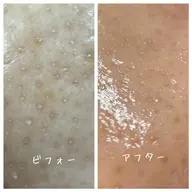大人気!毛穴の大掃除🧹ピーリングで小鼻つるつるに✨お肌のキメを整えてさらに美肌へ!小鼻ピーリング+超音波エステ