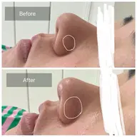 《鼻》お試し価格🥰小鼻の毛穴・ざらつき・黒ずみ！ワックスで改善！毛穴レスを目指して🫧１度で効果を感じられます♡