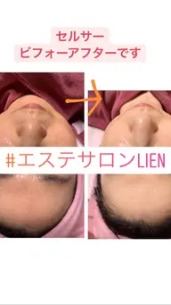 【No.1人気】フェイシャル　小顔、たるみ、くすみ　改善コース◎ご新規様価格8,800円