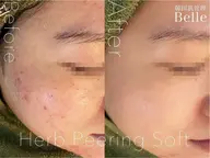 韓国ハーブピーリングBelle目黒限定☆※ご新規の方クチコミ必須メニュー