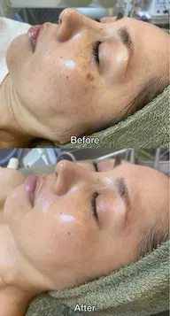 大好評につきお試し復活｜初回4000｜20分間シミ当て放題🌟 シミデトックス 20分当て放題 🌟