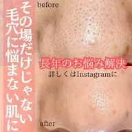 徹底毛穴ケア導入価格