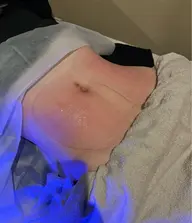 脂肪冷凍リポクール　体験