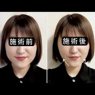 【エラ・二重アゴ・くいしばり】Vスティック×EMS×美容鍼