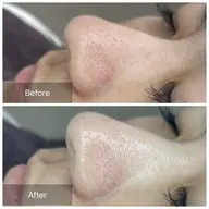 毛穴！黒ずみ！とにかく毛穴無くしたい人👸🏻💕フェイスワックス🫧（シートパック付／高保湿モデリングパック変更可）