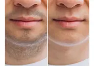 メンズ脱毛　最新LED全身丸投げ脱毛　[顔VIO込]　80分お顔のパックつき