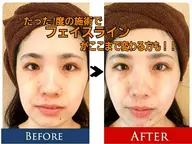 👑当店１番人気✨🎀3D小顔🎀フェイシャル体験&脱毛カウンセリング✨💓最新美容体験💝満足度98%👑