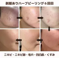 肌質改善☆顔ハーブピーリング・剥離あり 美容液導入