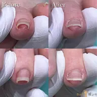 【陥入爪補正】皮膚に沈み込んだ爪も矯正でキレイに再生✨生活の痛みや違和感を改善致します💁♀️