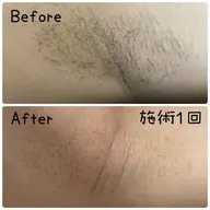 【レディース】結果重視!両わき美肌脱毛★ ¥2,200→¥1,100