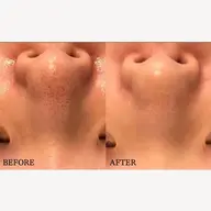 【2段階毛穴洗浄/肌診断付】幹細胞導入付きアクアポア毛穴洗浄¥12300→¥4400