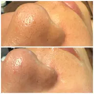 【毛穴ケア】毛穴や角質のザラつき気になる方におすすめ◎