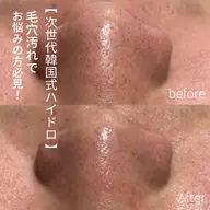 【韓国式毛穴洗浄】毛穴洗浄クーポン👃✨