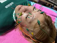 ✨ミニモ限定✨ 美容鍼たるみシワ予防 お試し 50分 メンズも大歓迎 通常10,000円⇒8,000円