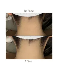 【 脇+うなじ+背中上脱毛🫧 】水着/前撮り/ウエディング/卒業式/入学式