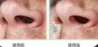 【WAX脱毛】鼻毛WAX